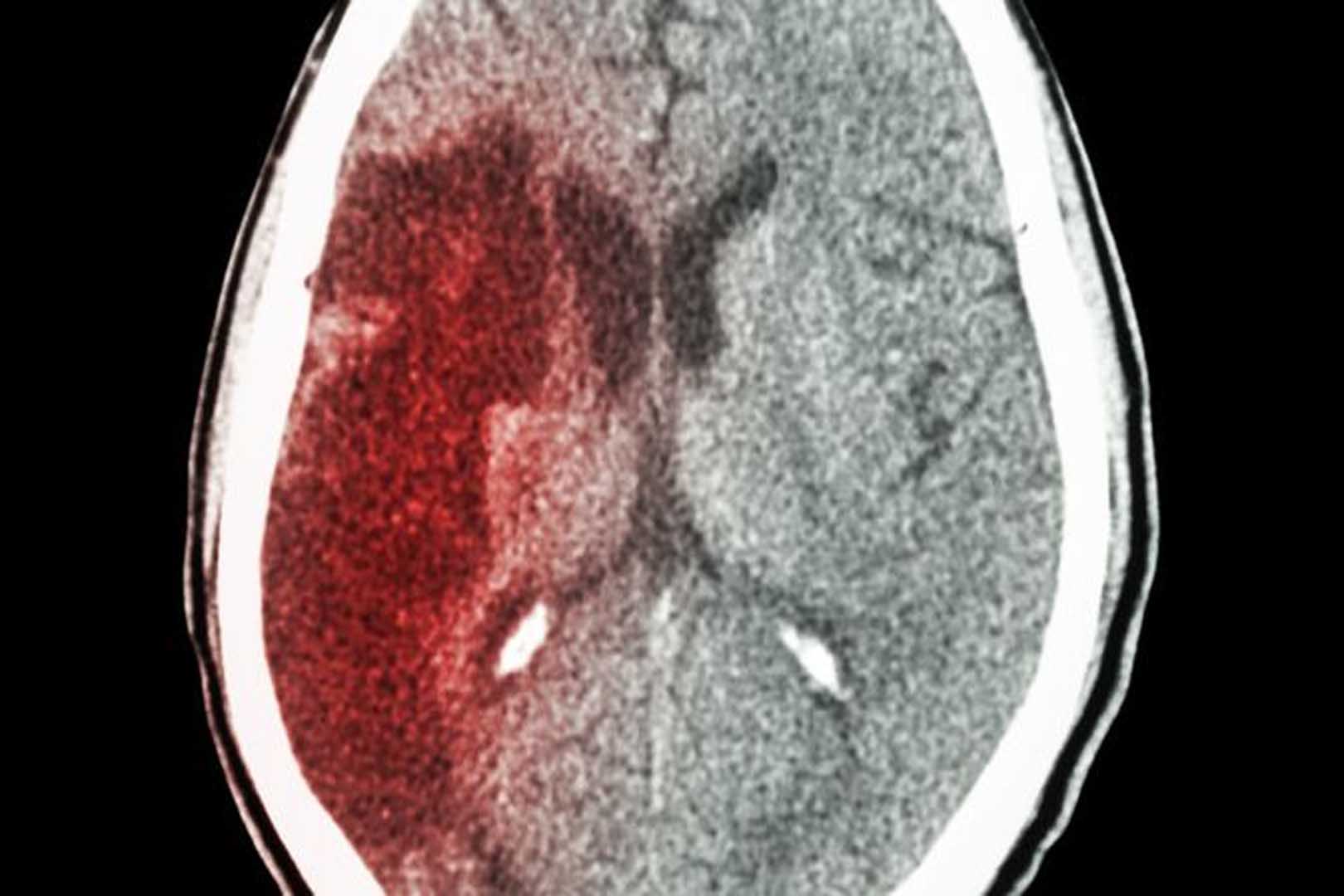 Mengenal Headstroke: Pencegahan dan Pengobatannya