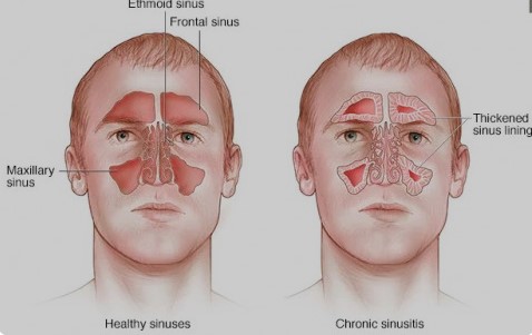 Atasi Sejak Dini dan Jangan Dianggap Remeh! Arti Sinusitis dan Cara Mengatasi  Ketika Terkena