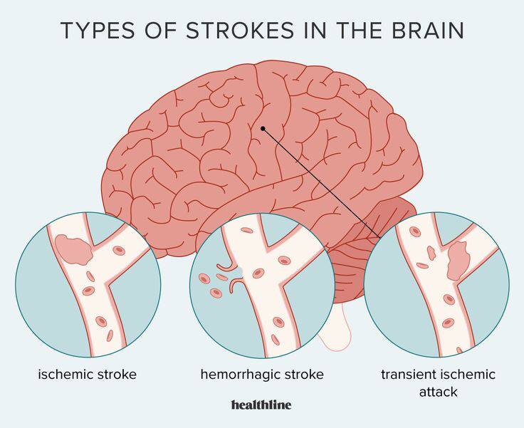 Kenali Penyebab Stroke yang Dialami Penyanyi Senior Betharia Sonata, Berikut Gejala dan Cara Mengatasinya!