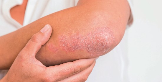 Psoriasis, Penyakit Kulit Yang Tidak Bisa Dianggap Remeh Ketika Udara Tercemar