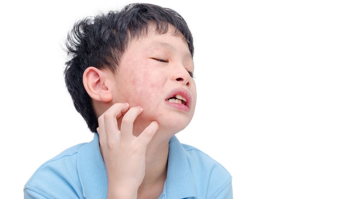 Ibu Jangan Panik! Simak Cara Mudah Atasi Alergi Kulit Pada Anak