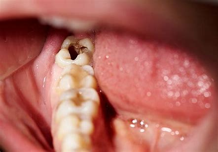 Kenali Penyebab Gigi Berlubang dan Bagaimana Cara Mengatasinya