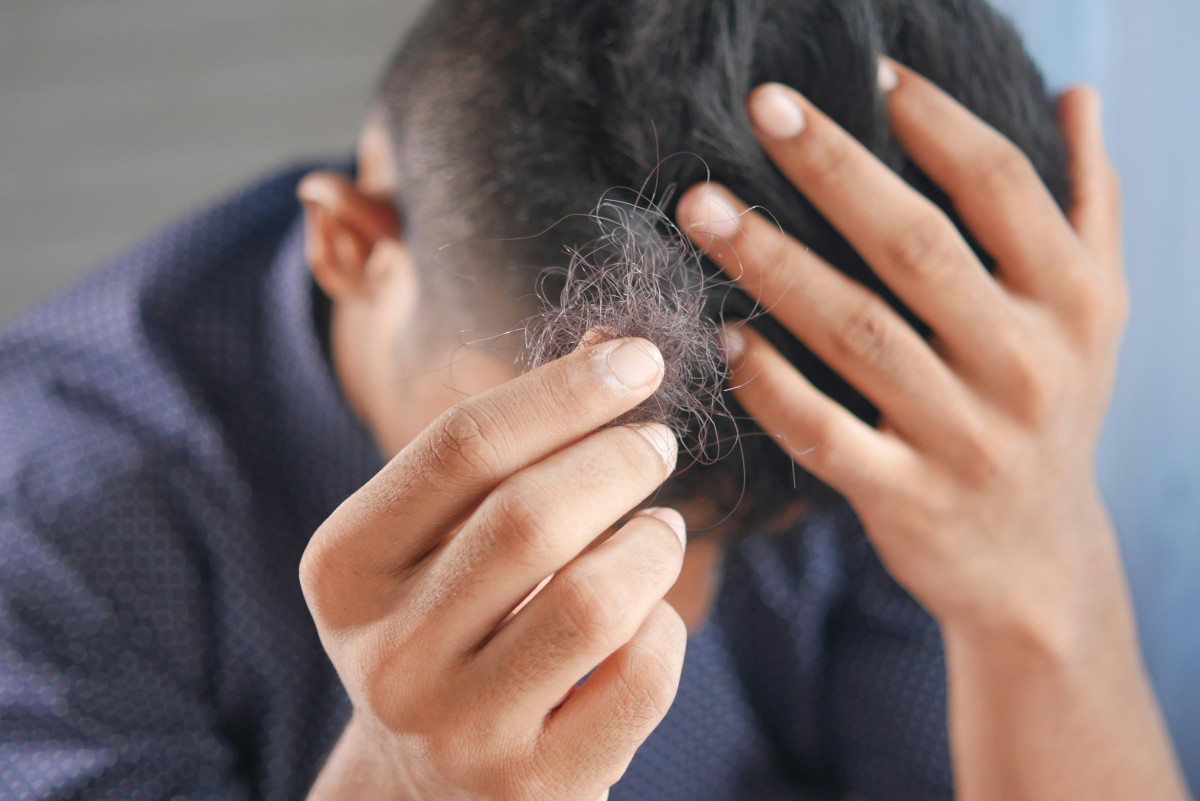 Atasi Rambut Rontok dan Kebotakan dengan 7 Jurus Ampuh Ini!