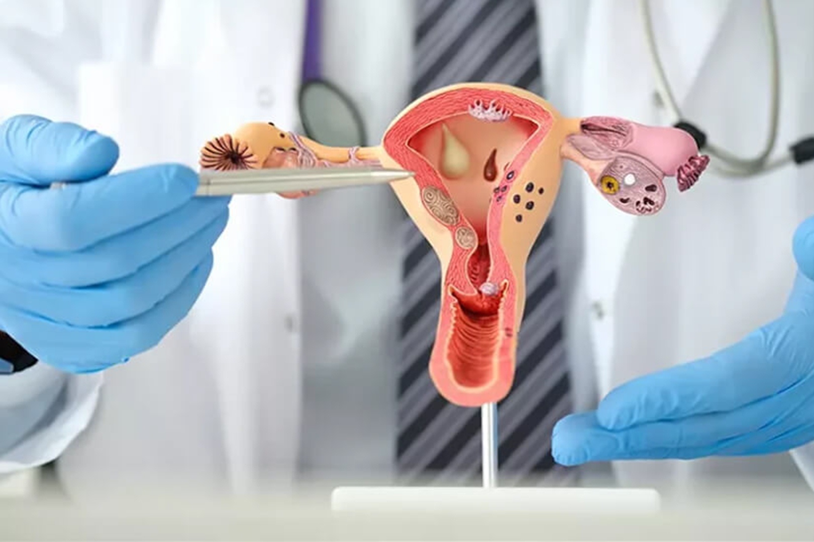 Polycystic Ovary Syndrome, Kenali dan Atasi Gangguan Hormonal yang Ganggu Kesuburan Wanita