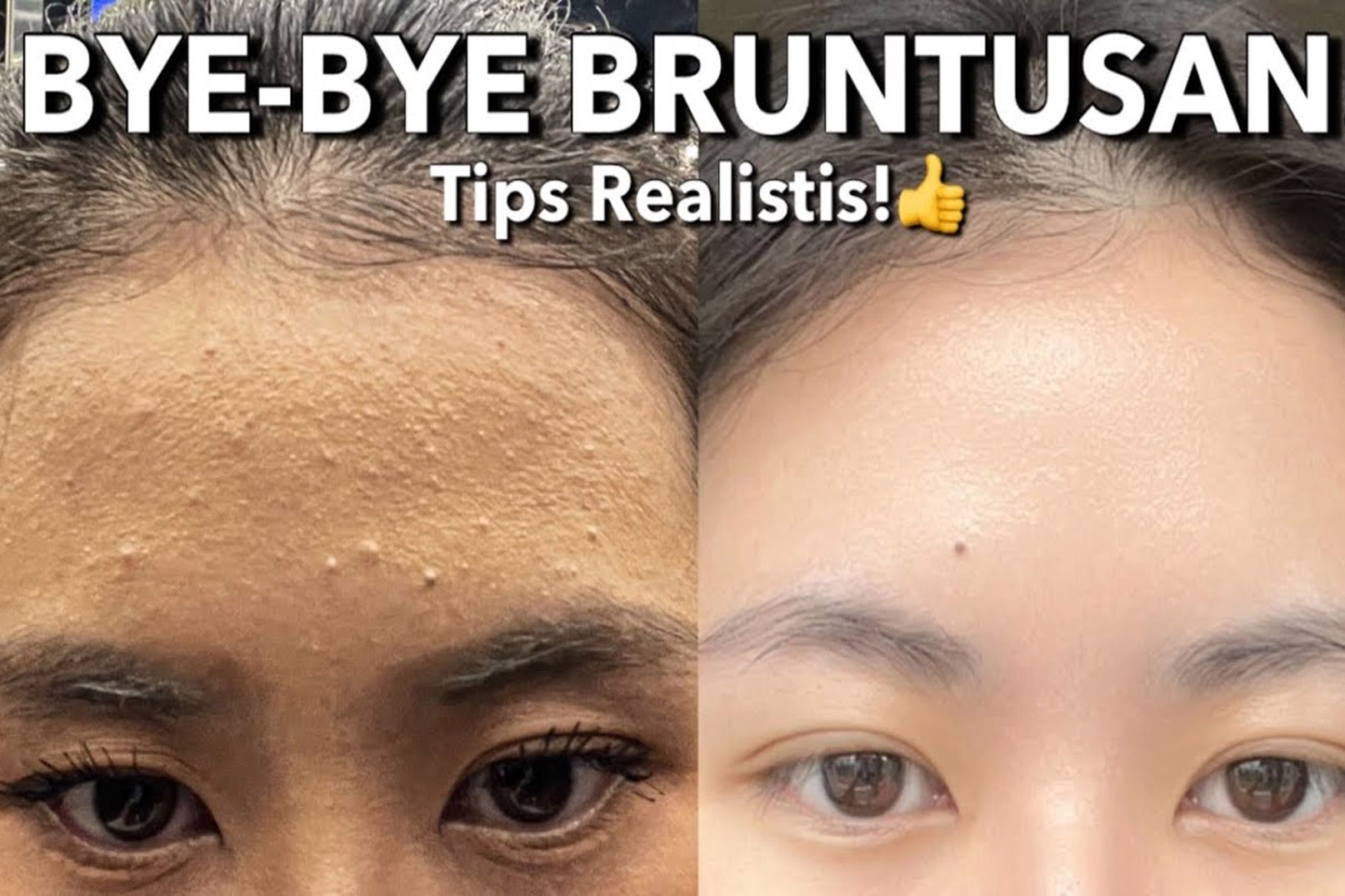 Mengatasi Kulit Bruntusan: Penyebab, Tips Ampuh, dan Produk Rekomendasi untuk Remaja