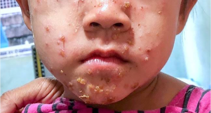 Impetigo Krustosa, Infeksi Kulit yang Membuat Anak Tak Nyaman