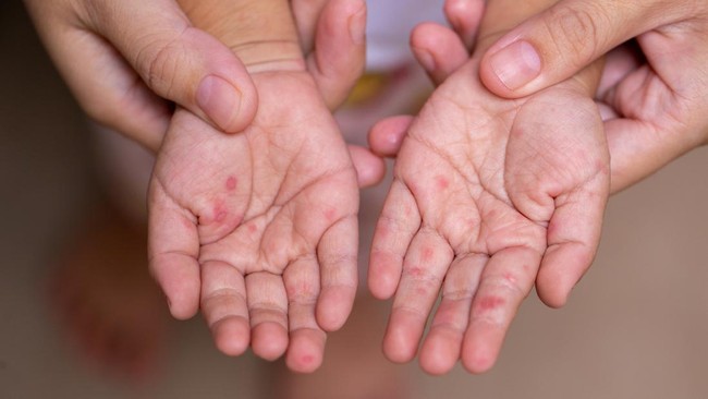 Waspada Scabies pada Anak yang Bisa Menular, Simak Cara Pencegahan dan Obatnya