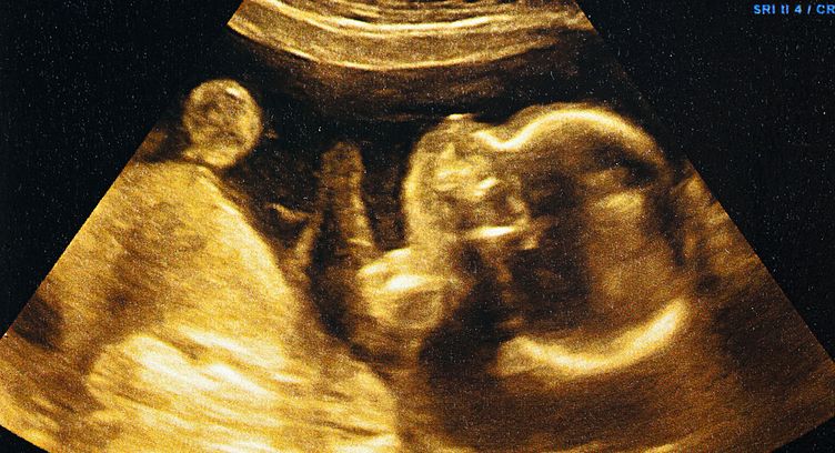 Apa itu Fetus In Fetu? Penyakit Langka yang Diidap Bayi 5 Bulan di Sumbar