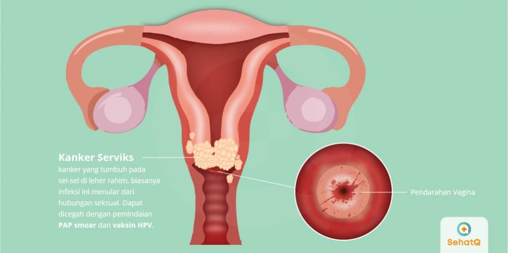 Waspada! Virus HPV Penyebab Kanker Serviks dan Kutil: Cegah Agar Rahim di Kandungan Selamat 