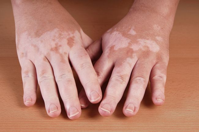 Gejala dan Penyebab Penyakit Vitiligo pada Manusia: Dampaknya Signifikan Terhadap Kualitas Hidup