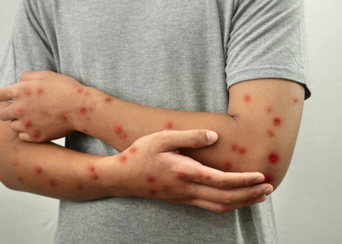 Waspada! Begini Cara Penyebaran Virus Mpox di Indonesia, Hampir Mirip Covid-19