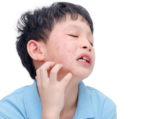 Ibu Jangan Panik! Simak Cara Mudah Atasi Alergi Kulit Pada Anak