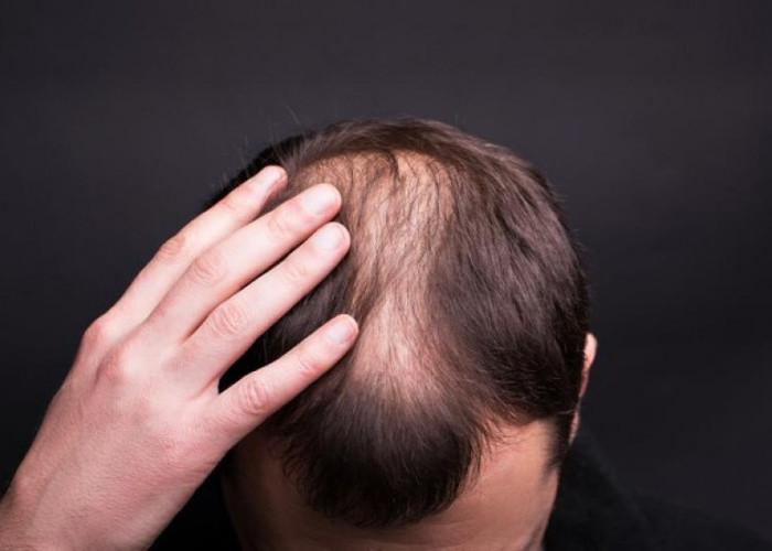 Waspada! Sering Alami Kerontokan Rambut Bisa Jadi Terserang Penyakit Diabetes, Cek Tanda-Tendanya?