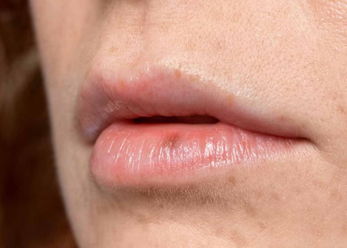 Mengobati Bibir Pecah-Pecah: Tips dan Pengobatan yang Efektif