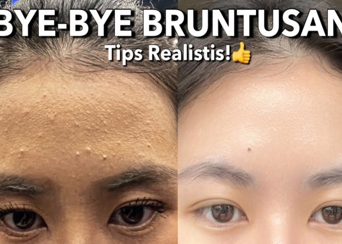 Mengatasi Kulit Bruntusan: Penyebab, Tips Ampuh, dan Produk Rekomendasi untuk Remaja