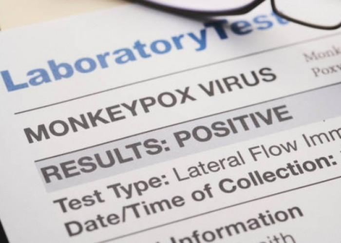 Update Data Kasus Cacar Monyet Hari Ini, 36 Pasien yang Terinfeksi Virus MonkeyPox
