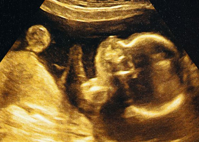 Apa itu Fetus In Fetu? Penyakit Langka yang Diidap Bayi 5 Bulan di Sumbar