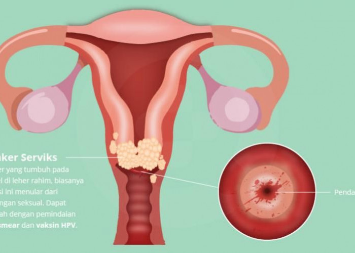 Waspada! Virus HPV Penyebab Kanker Serviks dan Kutil: Cegah Agar Rahim di Kandungan Selamat 