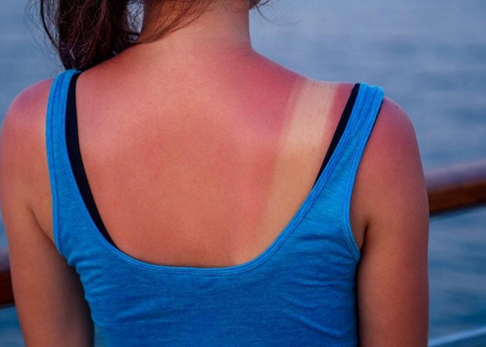 Menghindari Sunburn: Penyebab, Dampak, dan Cara Pengobatannya