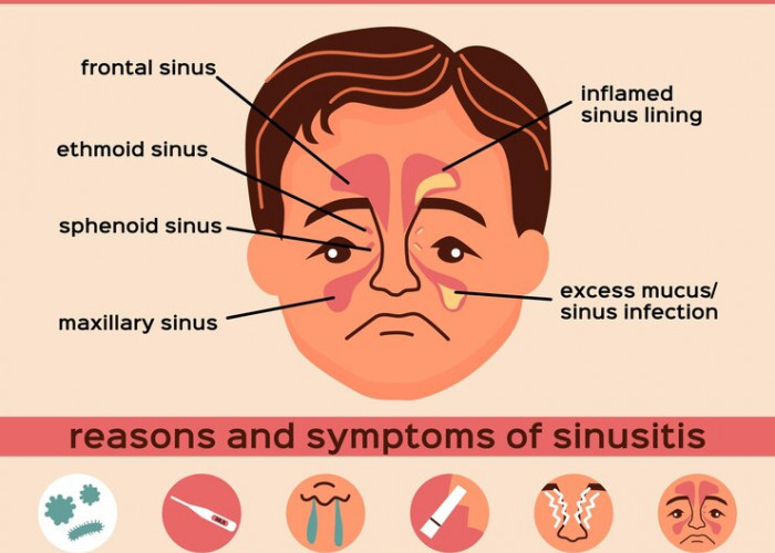Mengenal Gejala, Penyebab, dan Cara Mengatasi Sinusitis